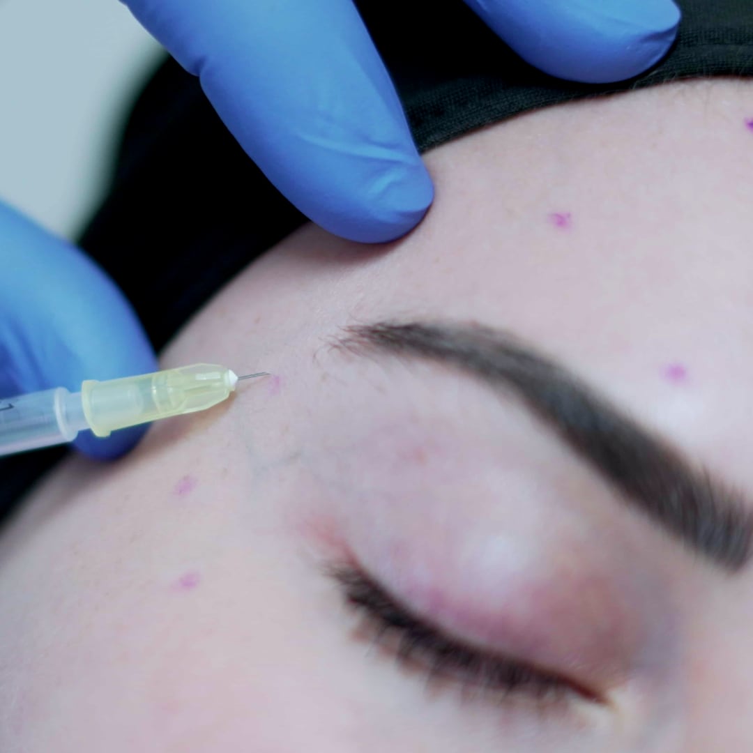 Alın Botoks Uygulaması - Dr. Ahmet Karaçam - Nişantaşı