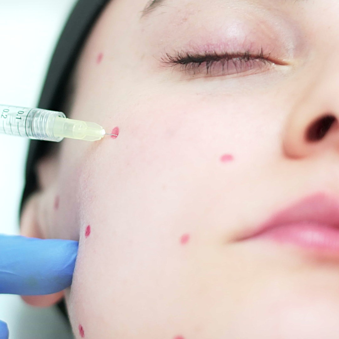 Eksozom Uygulaması - Dr. Ahmet Karaçam - Nişantaşı