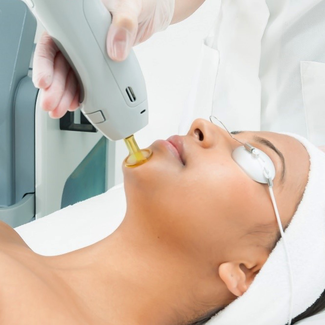 Lazer Epilasyon - Dr. Ahmet Karaçam - Nişantaşı