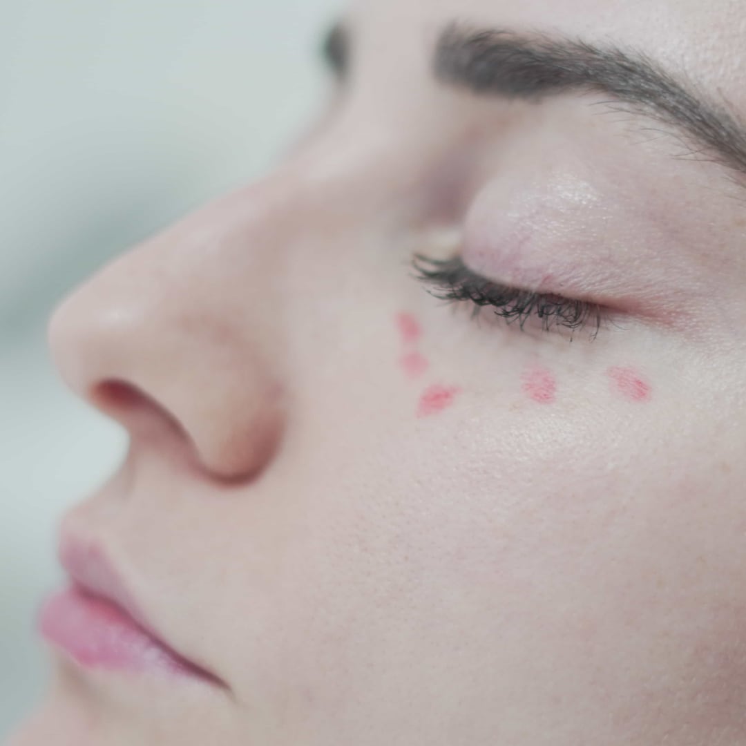 Göz Altı Işık Dolgusu - Dr. Ahmet Karaçam - Nişantaşı