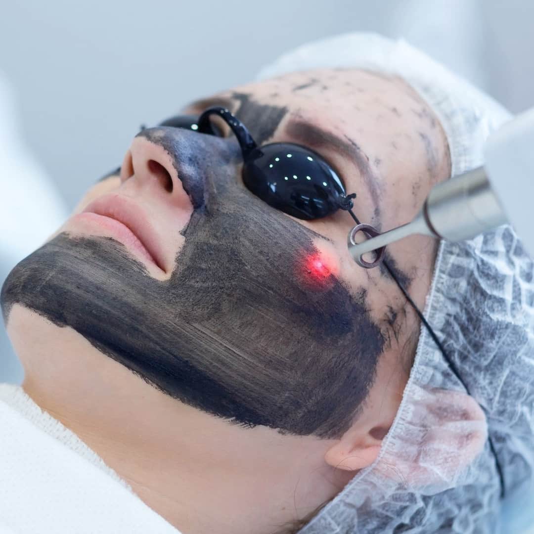Karbon Peeling - Dr. Ahmet Karaçam - Nişantaşı