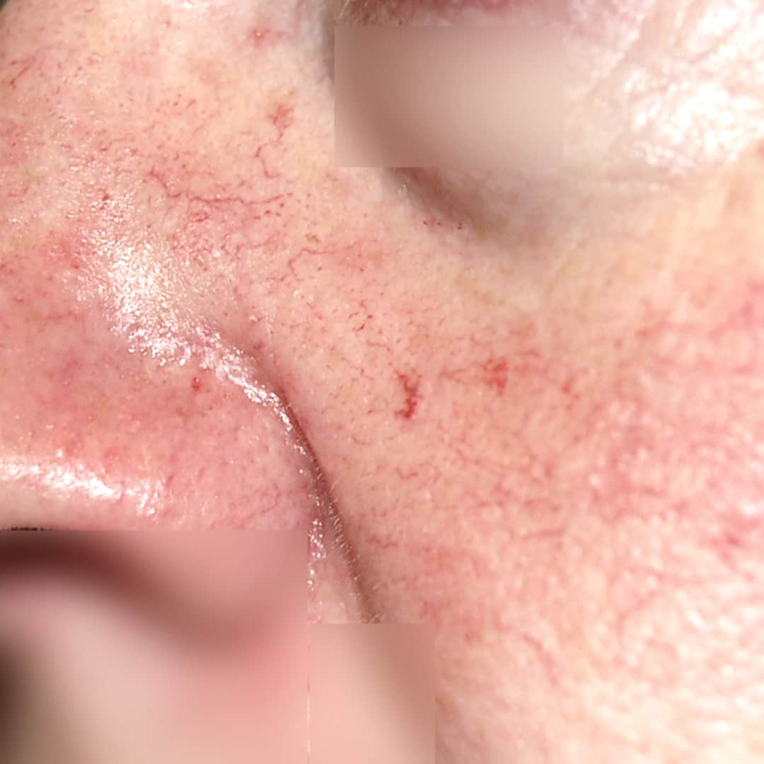 Kılcal Damar Tedavisi - Dr. Ahmet Karaçam - Nişantaşı