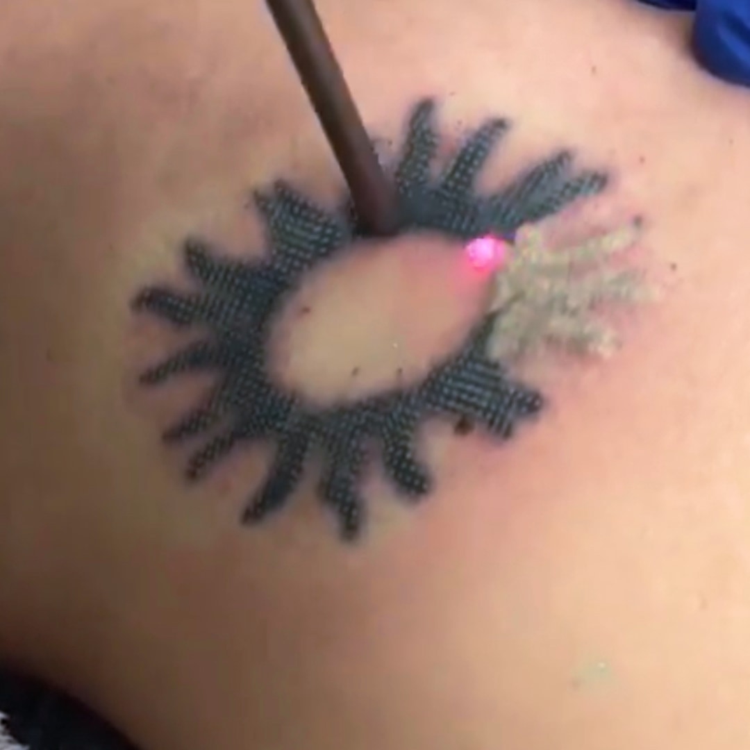 Lazerle Dövme Silme - Dr. Ahmet Karaçam - Nişantaşı