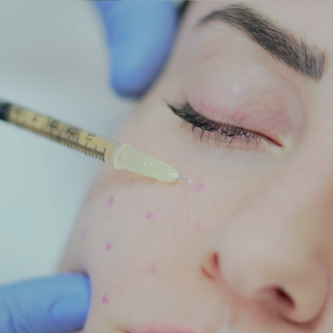 PRP Yüz Uygulaması - Dr. Ahmet Karaçam - Nişantaşı