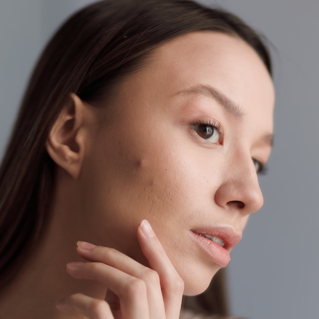 Sivilce ve Akne İzi - Dr. Ahmet Karaçam - Nişantaşı