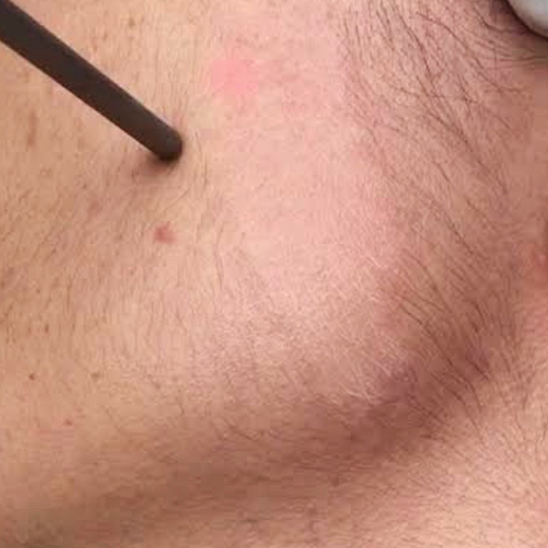 Lazerle Tüy Sarartma - Dr. Ahmet Karaçam - Nişantaşı