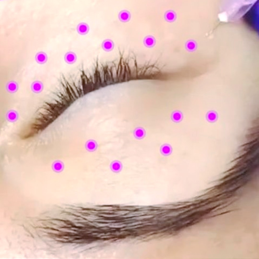 Mezoterapi - Dr. Ahmet Karaçam - Nişantaşı