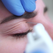 Plexr ile Üst Göz Kapağı Yenileme - Dr. Ahmet Karaçam - Nişantaşı