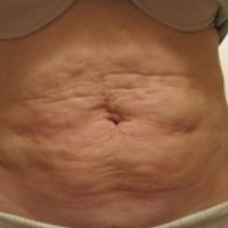 Velashape - Dr. Ahmet Karaçam - Nişantaşı