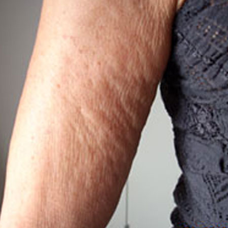 Velashape - Dr. Ahmet Karaçam - Nişantaşı