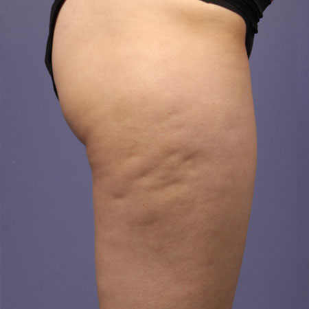 Velashape - Dr. Ahmet Karaçam - Nişantaşı