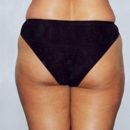 Velashape - Dr. Ahmet Karaçam - Nişantaşı